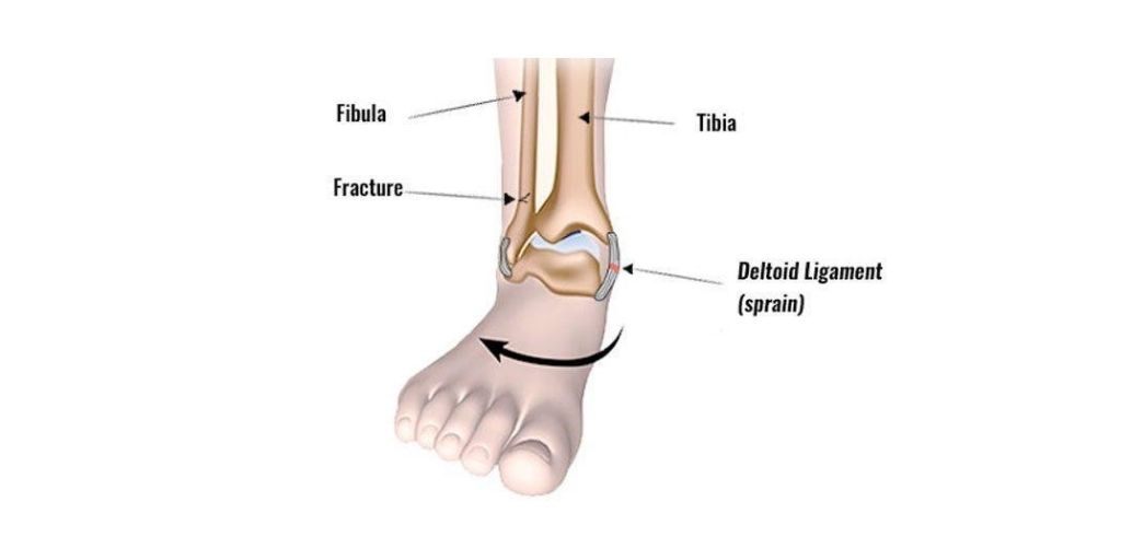 Medial ankle sprain